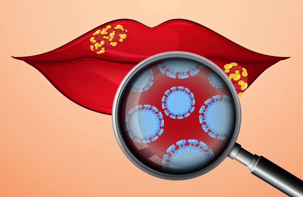 Herpes Virus